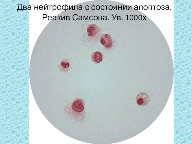 Два нейтрофила с состоянии апоптоза. Реакив Самсона. Ув. 1000х