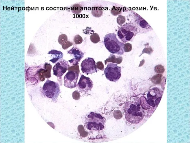 Нейтрофил в состоянии апоптоза. Азур-эозин. Ув. 1000х
