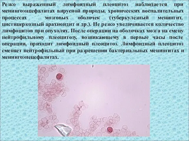Резко выраженный лимфоидный плеоцитоз наблюдается при менингоэнцефалитах вирусной природы, хронических
