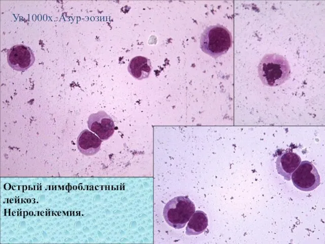 Острый лимфобластный лейкоз. Нейролейкемия. Ув.1000х. Азур-эозин.