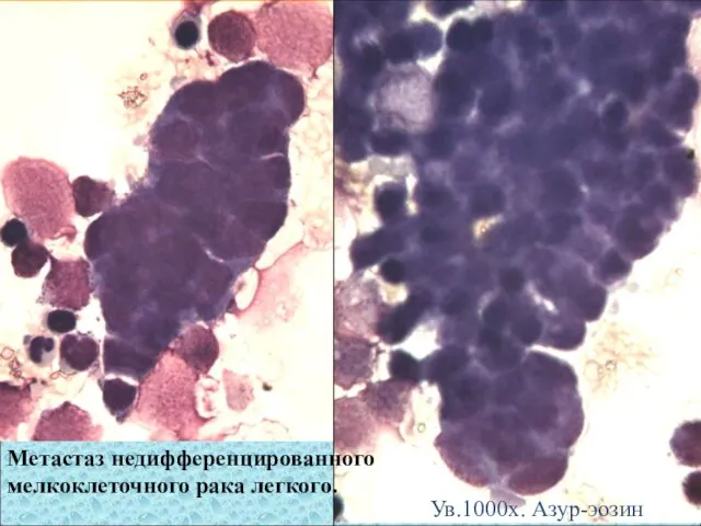 Метастаз недифференцированного мелкоклеточного рака легкого. Ув.1000х. Азур-эозин