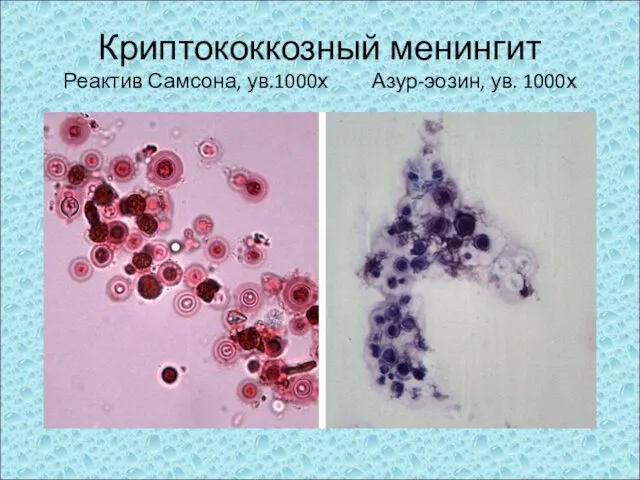 Криптококкозный менингит Реактив Самсона, ув.1000х Азур-эозин, ув. 1000х