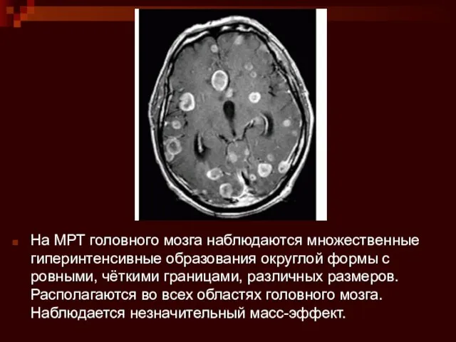 На МРТ головного мозга наблюдаются множественные гиперинтенсивные образования округлой формы