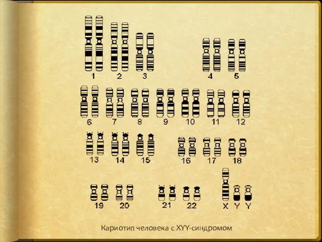 Кариотип человека с XYY-синдромом