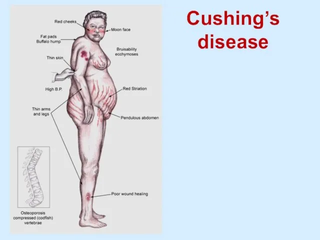 Cushing’s disease