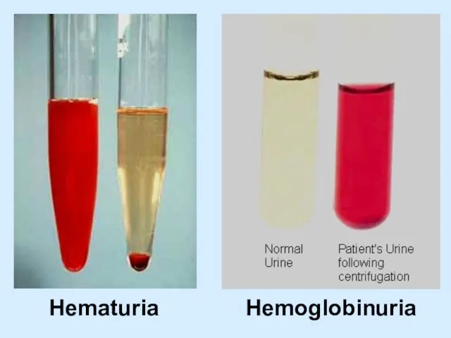 Hematuria Hemoglobinuria