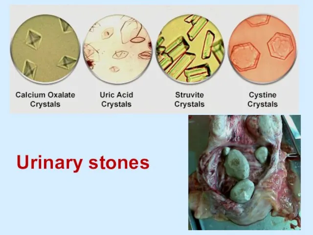 Urinary stones