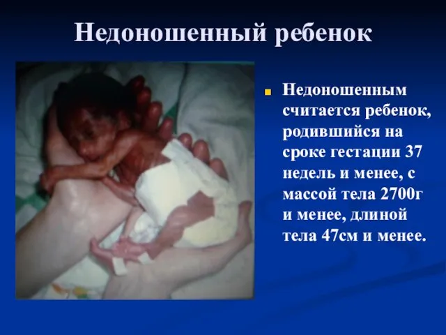Недоношенный ребенок Недоношенным считается ребенок, родившийся на сроке гестации 37