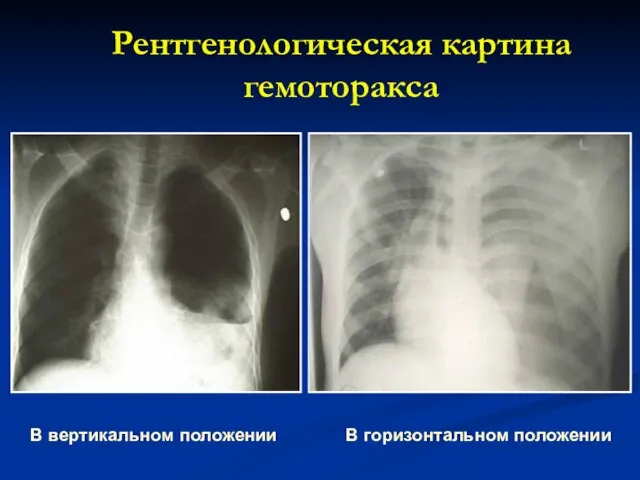 Рентгенологическая картина гемоторакса В вертикальном положении В горизонтальном положении