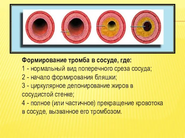 Формирование тромба в сосуде, где: 1 - нормальный вид поперечного