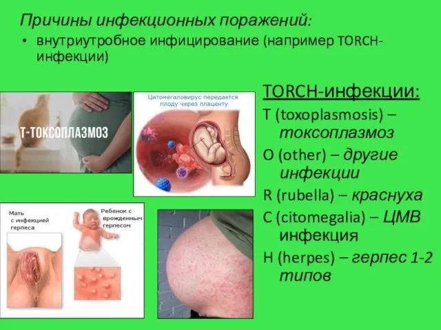Причины инфекционных поражений: внутриутробное инфицирование (например TORCH-инфекции) TORCH-инфекции: T (toxoplasmosis)