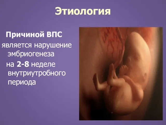 Этиология Причиной ВПС является нарушение эмбриогенеза на 2-8 неделе внутриутробного периода