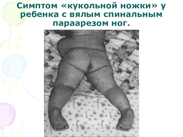 Симптом «кукольной ножки» у ребенка с вялым спинальным параарезом ног.