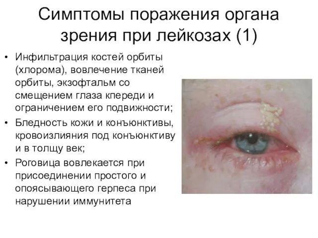 Симптомы поражения органа зрения при лейкозах (1) Инфильтрация костей орбиты