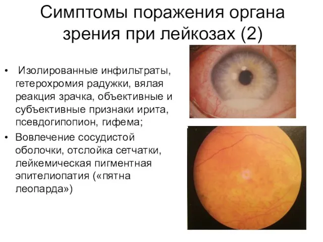 Симптомы поражения органа зрения при лейкозах (2) Изолированные инфильтраты, гетерохромия