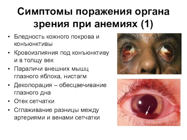 Симптомы поражения органа зрения при анемиях (1) Бледность кожного покрова