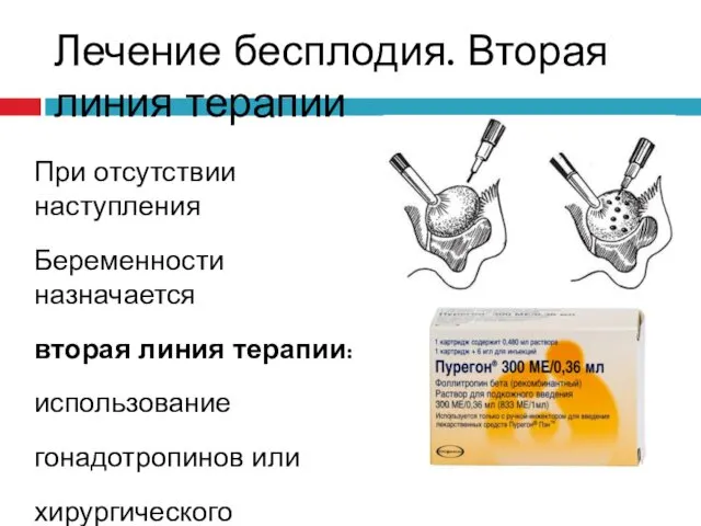 Лечение бесплодия. Вторая линия терапии При отсутствии наступления Беременности назначается