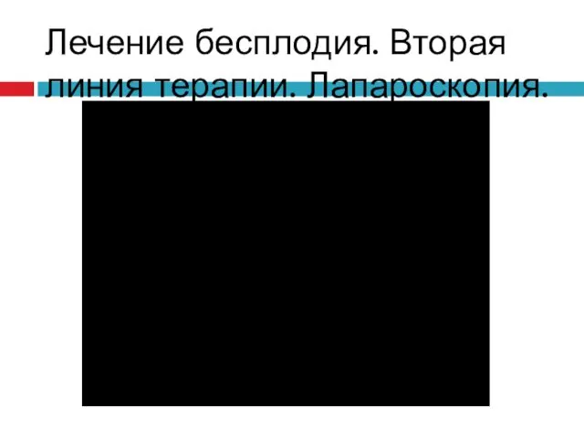 Лечение бесплодия. Вторая линия терапии. Лапароскопия.