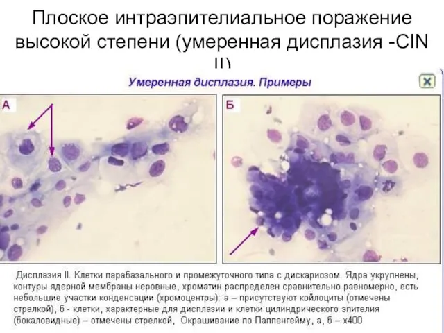 Плоское интраэпителиальное поражение высокой степени (умеренная дисплазия -CIN II)