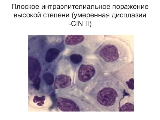 Плоское интраэпителиальное поражение высокой степени (умеренная дисплазия -CIN II)