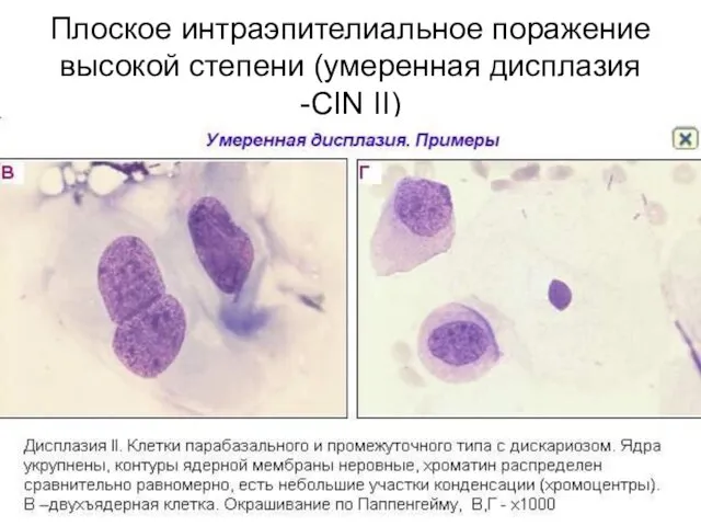 Плоское интраэпителиальное поражение высокой степени (умеренная дисплазия -CIN II)