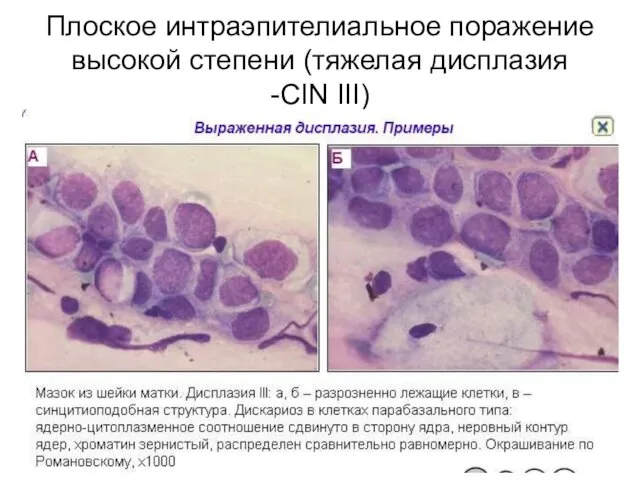 Плоское интраэпителиальное поражение высокой степени (тяжелая дисплазия -CIN III)