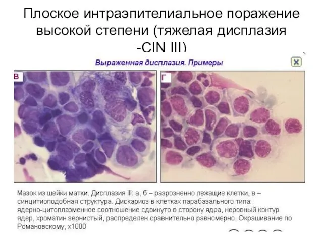 Плоское интраэпителиальное поражение высокой степени (тяжелая дисплазия -CIN III)