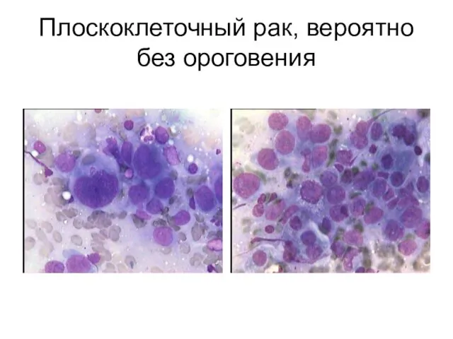 Плоскоклеточный рак, вероятно без ороговения