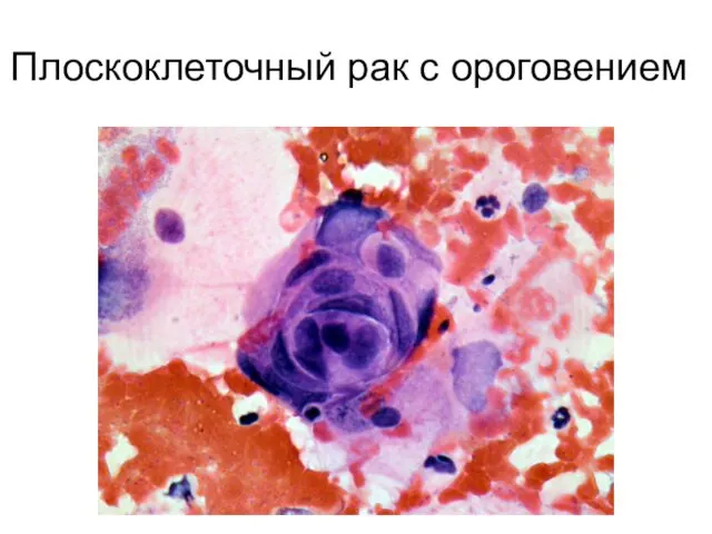 Плоскоклеточный рак с ороговением