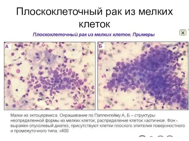 Плоскоклеточный рак из мелких клеток