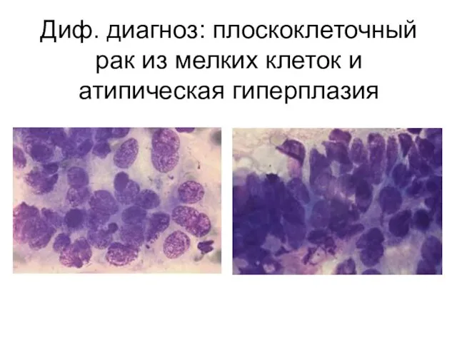 Диф. диагноз: плоскоклеточный рак из мелких клеток и атипическая гиперплазия