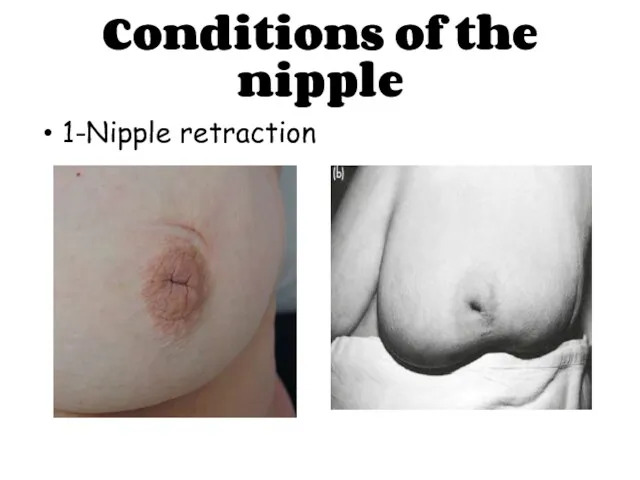 Conditions of the nipple 1-Nipple retraction