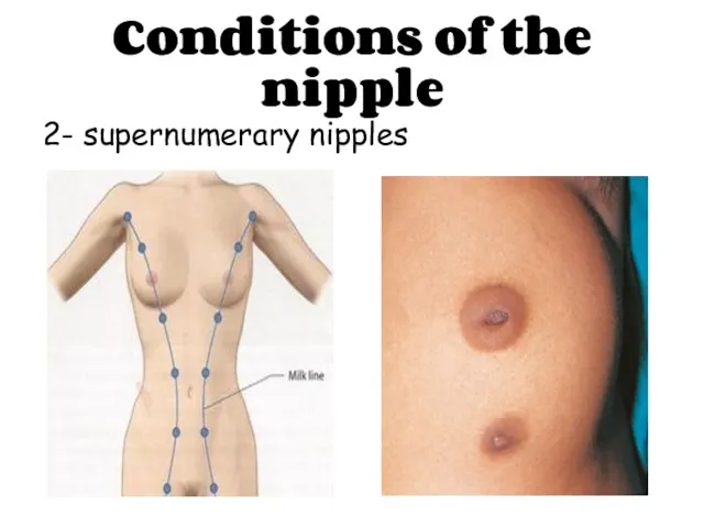 Conditions of the nipple 2- supernumerary nipples