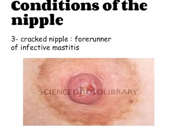 Conditions of the nipple 3- cracked nipple : forerunner of infective mastitis