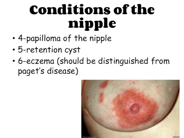 Conditions of the nipple 4-papilloma of the nipple 5-retention cyst