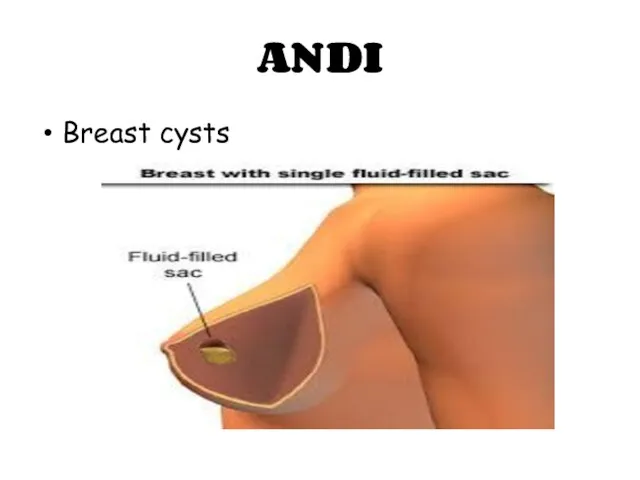 ANDI Breast cysts