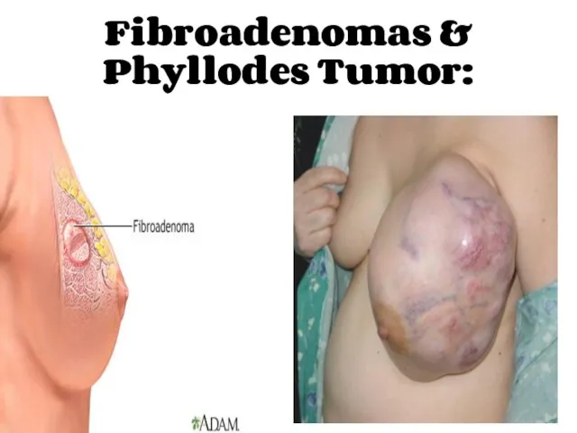 Fibroadenomas & Phyllodes Tumor: