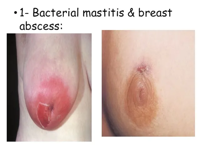 1- Bacterial mastitis & breast abscess: