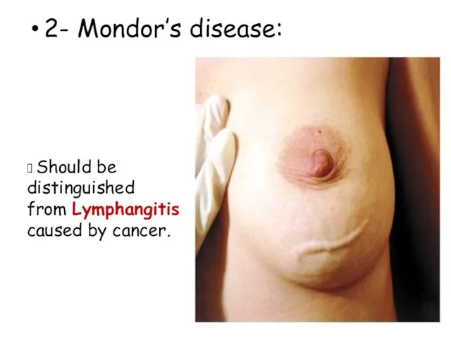 2- Mondor’s disease: ? Should be distinguished from Lymphangitis caused by cancer.
