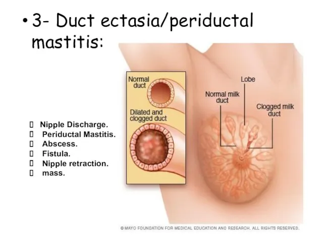 3- Duct ectasia/periductal mastitis: Nipple Discharge. Periductal Mastitis. Abscess. Fistula. Nipple retraction. mass.