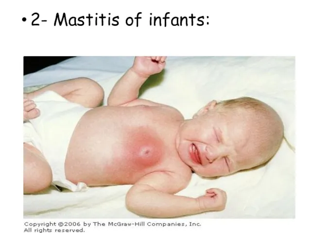 2- Mastitis of infants: