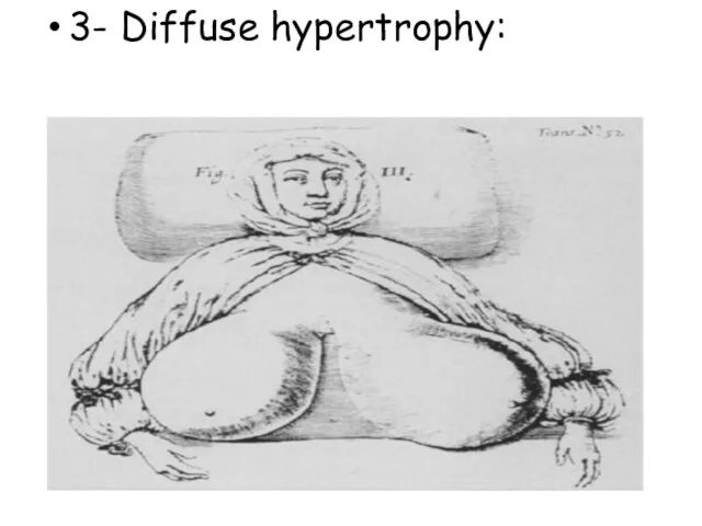 3- Diffuse hypertrophy: