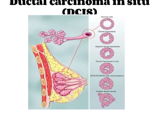 Ductal carcinoma in situ (DCIS)