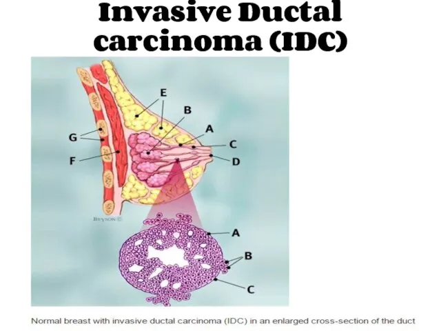 Invasive Ductal carcinoma (IDC)