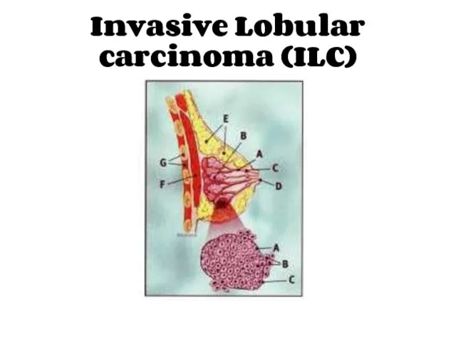 Invasive Lobular carcinoma (ILC)