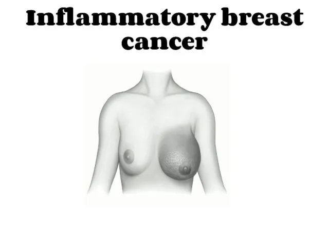 Inflammatory breast cancer