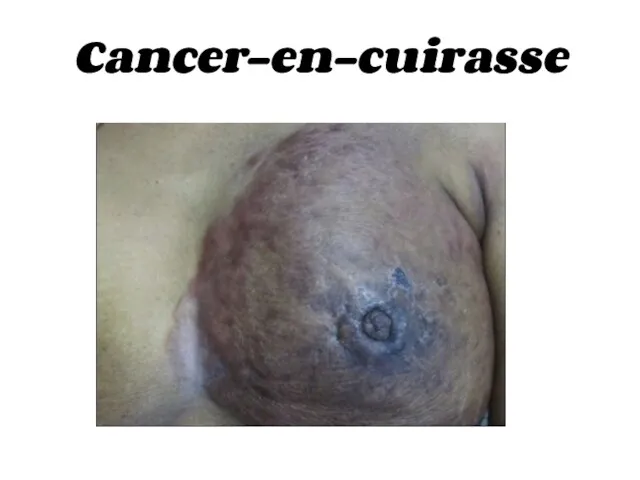 Cancer-en-cuirasse