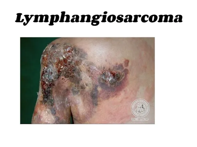 Lymphangiosarcoma