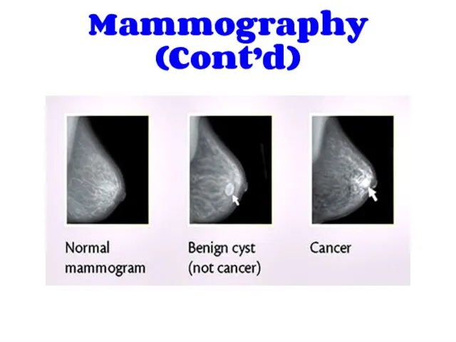 Mammography (Cont’d)