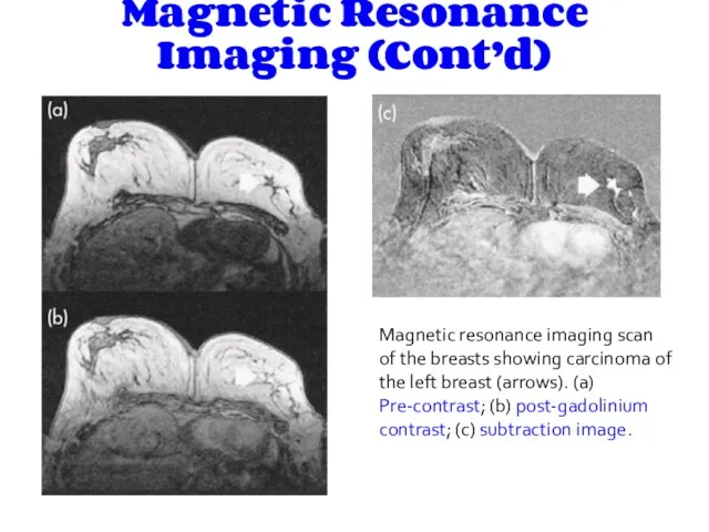 Magnetic Resonance Imaging (Cont’d) Magnetic resonance imaging scan of the